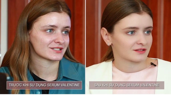 Điều kì diệu đã đến với Iryna sau 1 tuần sử dụng Serum Valentine