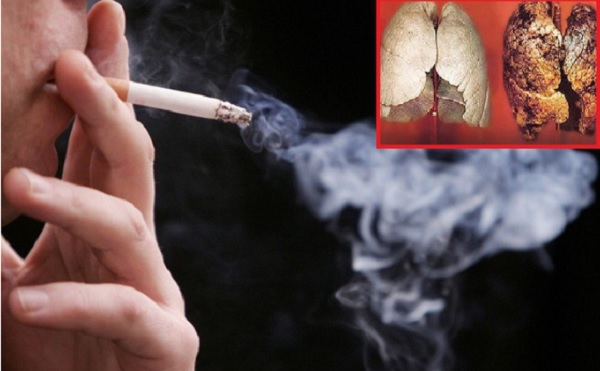 Khói thuốc lá là nguyên nhân hàng đầu gây ung thư phổi