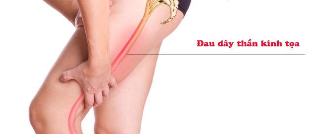 Đau buốt lưng lan xuống chân là biểu hiện của đau dây thần kinh tọa