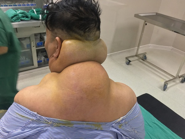 Khối u v&ugrave;ng cổ khiến bệnh nh&acirc;n kh&oacute; vận động, kh&ocirc;ng thể nằm ngửa