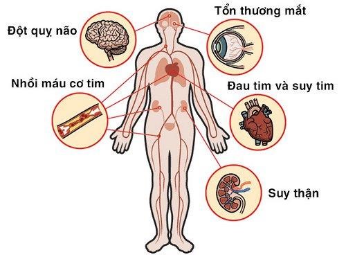 Các biến chứng nguy hiểm của tăng huyết áp vô căn