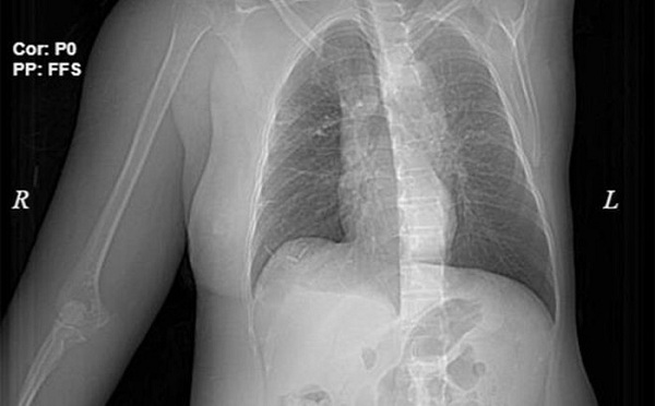 Điều trị ung thư sai phương pháp người phụ nữ bị lở loét ngực, phù tay