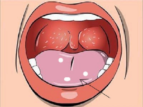 Vi khuẩn, virus là nguyên nhân chính gây nên các bệnh viêm loét ở khoang miệng
