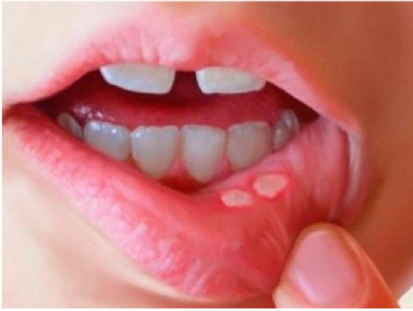 Tỷ lệ mắc các bệnh viêm loét khoang miệng ngày càng tăng