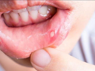 Nhiệt miệng, nhiệt lưỡi, nhiệt lợi, nhiệt miệng áp tơ là những bệnh lý ở khoang miệng phổ biến