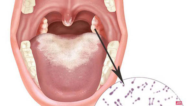 Triệu chứng dễ nhận thấy nhất của bệnh bạch hầu là hình thành mảng màu xám, dày ở họng và amidan.