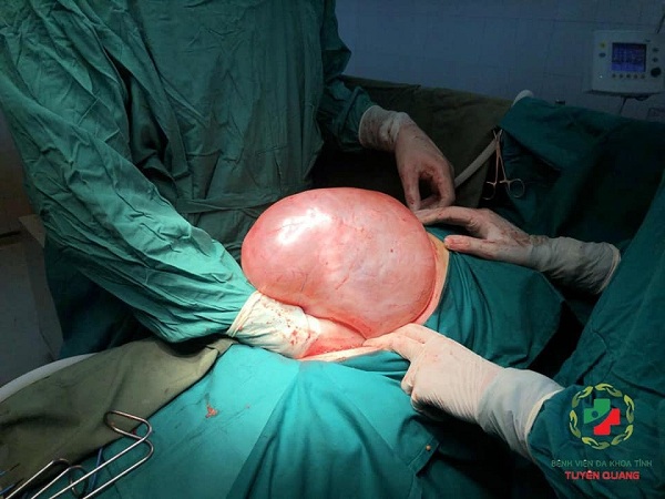 Ca phẫu thuật cắt bỏ khối u buồng trứng cho bệnh nhân.