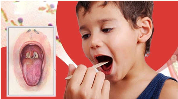 Cảnh báo biến chứng nguy hiểm do bệnh bạch hầu