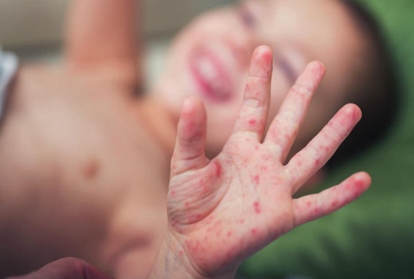 Cả nước có gần 11.000 ca mắc tay chân miệng