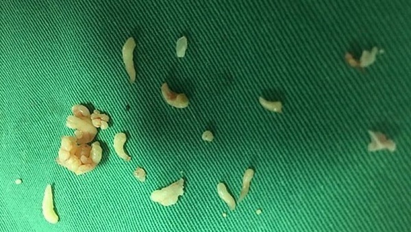 Phẫu thuật lấy ra gần 20 chiếc răng trong khối u của bệnh nhân 12 tuổi tại Phú Thọ