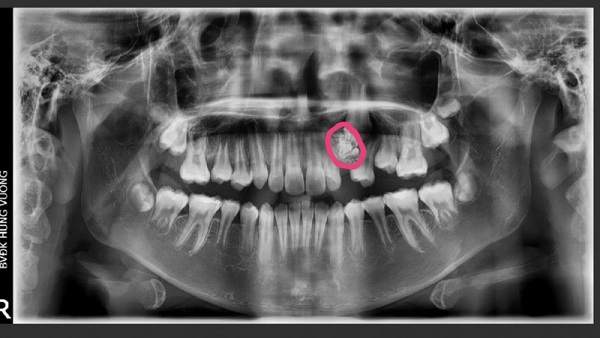 Khối u răng qua h&igrave;nh ảnh X - quang răng to&agrave;n cảnh.