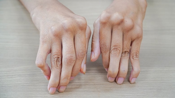 Đôi bàn tay co quắp do bệnh lý Viêm khớp dạng thấp, ngày càng tiến triển nặng, không chỉ hỏng mà các khớp bàn - ngón tay cũng bị trật dẫn đến các ngón tay của bệnh nhân vẹo sang một bên. Y văn gọi là bàn tay gió thổi và mu bàn tay hình lưng lạc đà