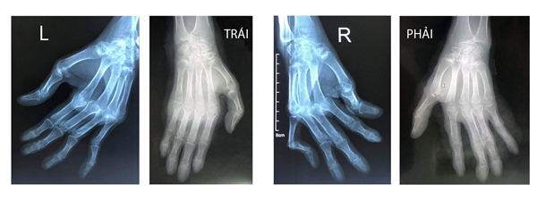 Hình ảnh X-quang bàn tay bệnh nhân trước và sau ca mổ cho thấy đã phục hồi lại trục các khớp, cân bằng phần mềm; đảm bảo cho ngón tay cử động như bình thường