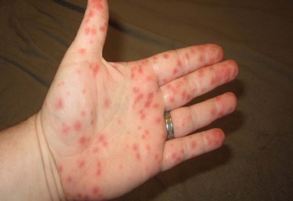 Các nốt ban đỏ nổi trên da, dấu hiệu đặc trưng của bệnh sốt xuất huyết - Ảnh: BVCC
