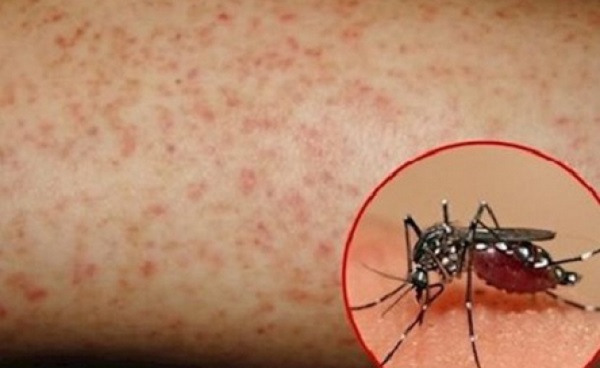 Cả nước có hơn 84.000 người mắc sốt xuất huyết