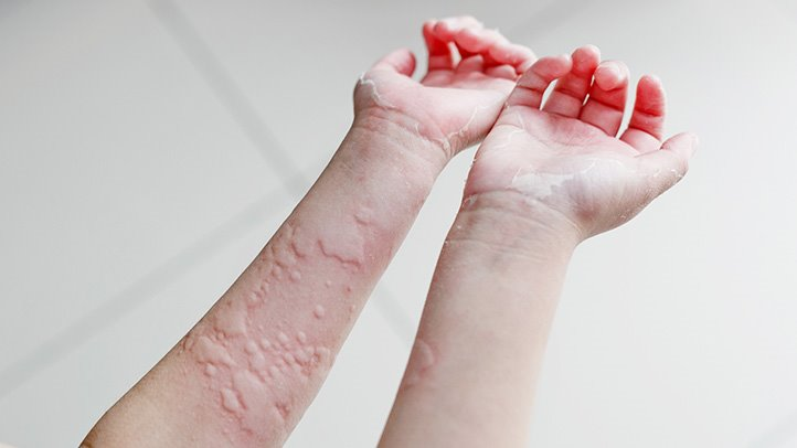 Sẩn phù nổi gờ trên bề mặt da là triệu chứng điển hình của mề đay mạn tính