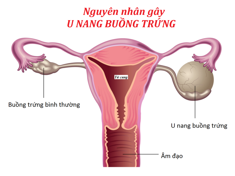 Có nhiều nguyên nhân gây u nang buồng trứng