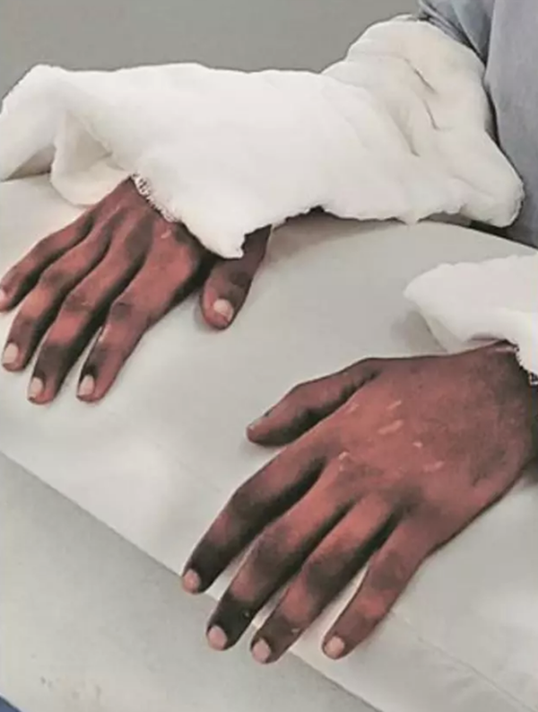 Đôi tay sau cấy ghép Đôi tay sau cấy ghép