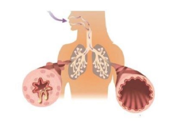 Tái cấu trúc đường thở khiến cho người bệnh ho lâu ngày không khỏi