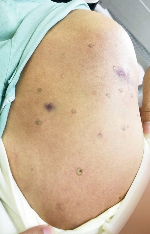 Người bệnh bị hơn 100 nốt ong đốt khắp to&agrave;n th&acirc;n