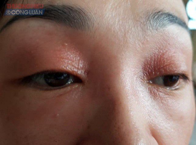 Chị H bị ngứa rát, đỏ ửng mặt sau khi đi trị nám tại 56 Nguyễn Du