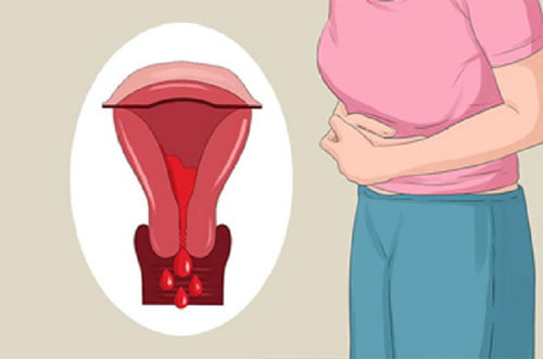 Rong kinh là tình trạng phổ biến khi bị u xơ tử cung