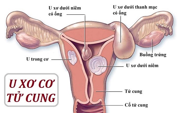 U xơ tử cung là bệnh phụ khoa phổ biến ở nữ giới
