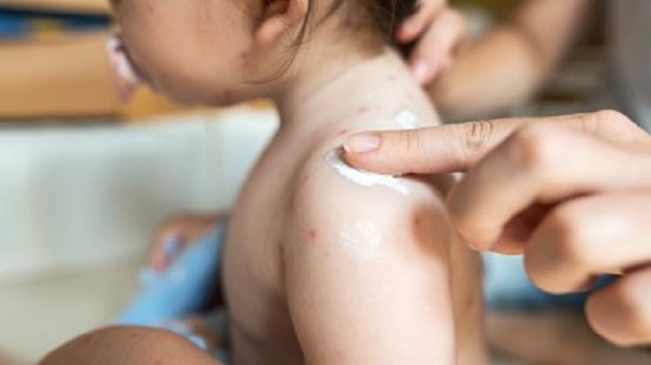 Thoa kem dưỡng giúp làm mát da của trẻ