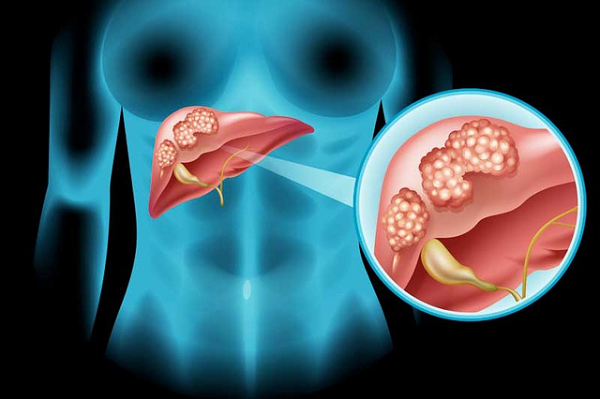 Ung thư phổi có thể di căn đến gan gây nhiều triệu chứng