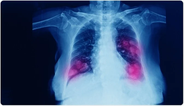 Ung thư phổi có thể di căn đến nhiều nơi trên cơ thể