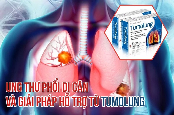 Thông tin về ung thư phổi di căn và giải pháp hỗ trợ từ Tumolung