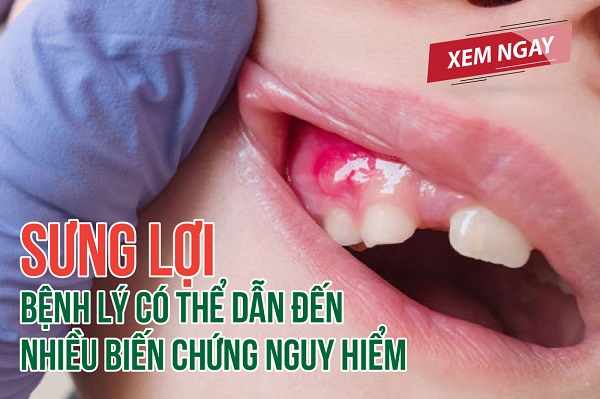 Sưng lợi – Bệnh lý có thể dẫn đến nhiều biến chứng nguy hiểm