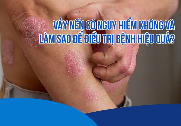 Vảy nến có nguy hiểm không và làm sao để điều trị bệnh hiệu quả?