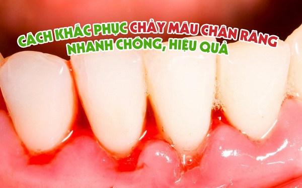 Cách khắc phục chảy máu chân răng nhanh chóng, hiệu quả nhất
