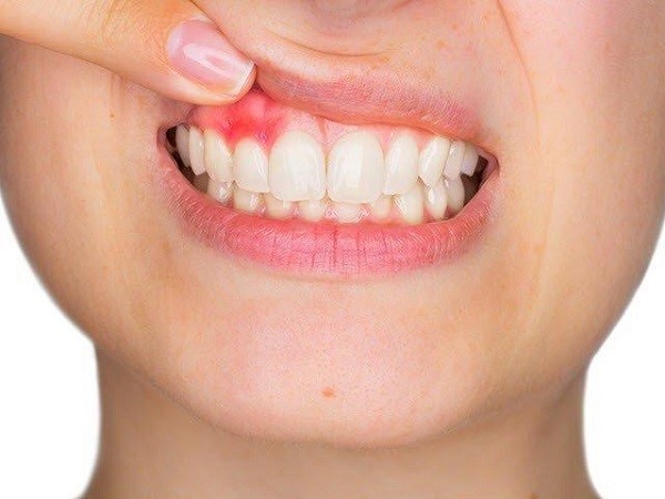 Viêm lợi lâu ngày dễ gây ra chảy máu chân răng