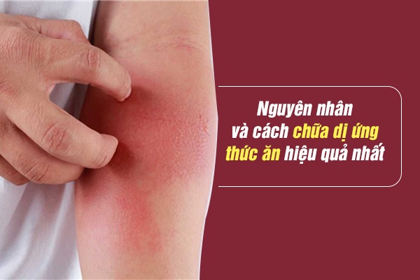 Nguyên nhân và cách chữa dị ứng thức ăn hiệu quả nhất