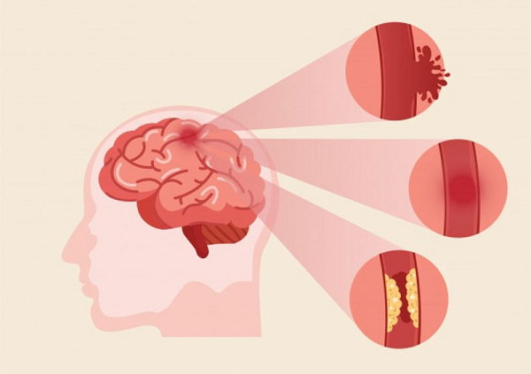 Cách dùng và liều lượng của kinh vương não bộ? 
