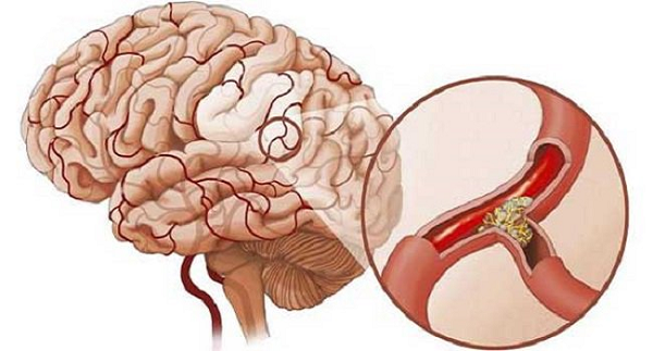 Cục máu đông được xem là nguyên nhân chính gây đột quỵ nhồi máu não