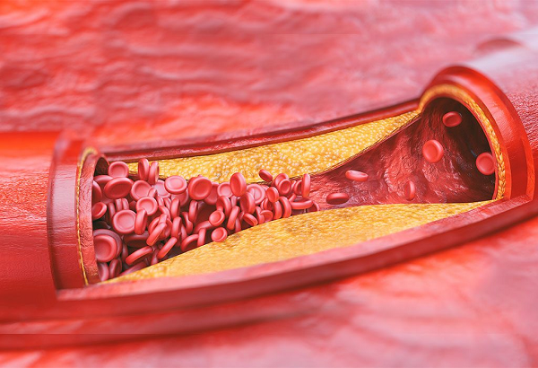 Xơ vữa động mạch là “thủ phạm” chính gây tai biến mạch máu não