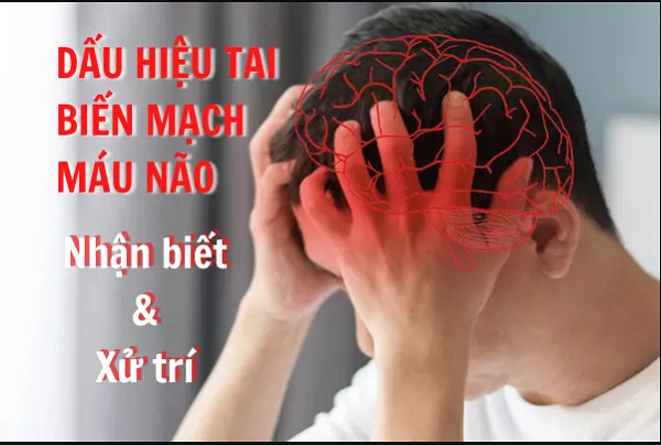 Dấu hiệu tai biến mạch máu não - Cách nhận biết và xử trí