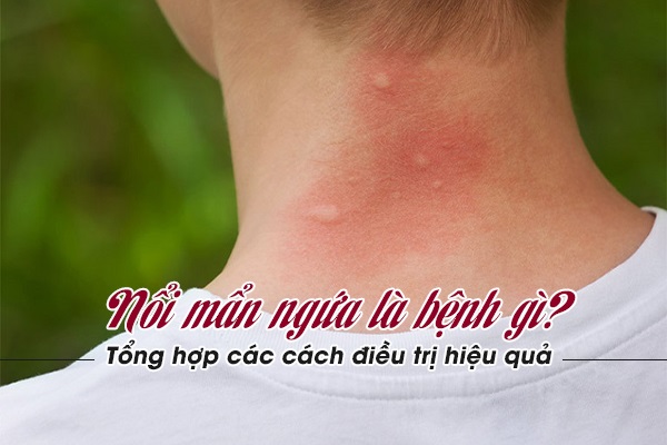Nổi mẩn ngứa là bệnh gì? Tổng hợp các cách điều trị hiệu quả