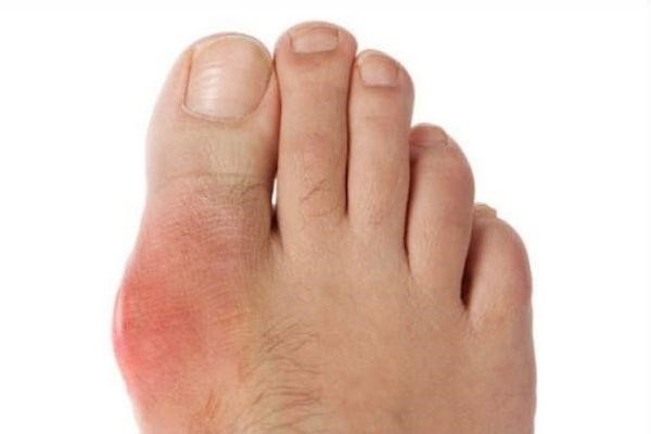 Gout là nguyên nhân phổ biến gây đau khớp
