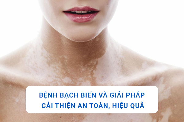 Bệnh bạch biến và giải pháp cải thiện an toàn, hiệu quả