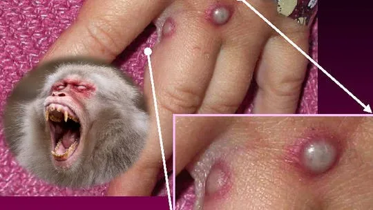 Xem xét mở rộng vaccine đậu mùa của Bavarian Nordic để ngăn ngừa bệnh đậu mùa khỉ