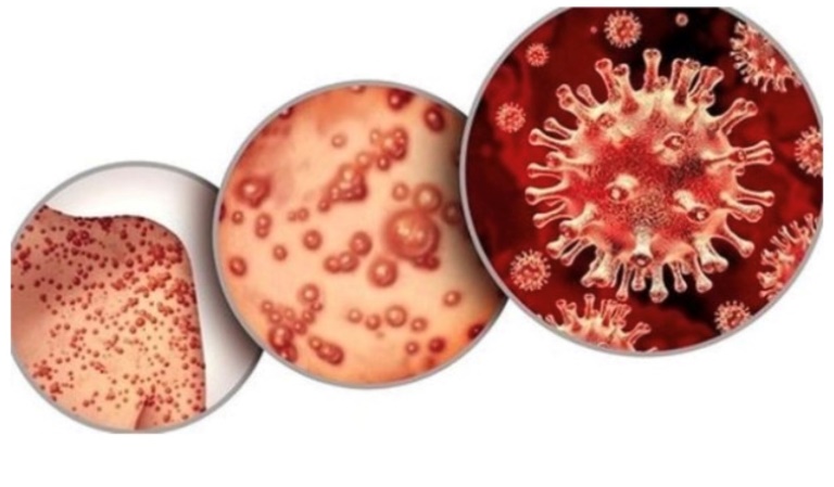 Virus đậu mùa lhi có thể lây lan khi tiếp xúc gần dưới bất kỳ hình thức nào