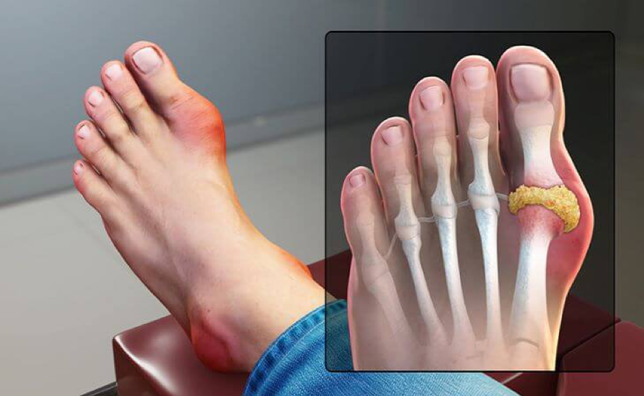 Cơn đau gout cấp thường xuất hiện ở khớp ngón chân cái
