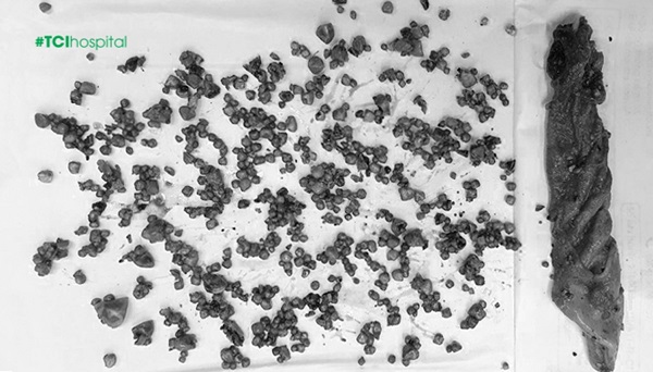 Hơn 500 viên sỏi lớn nhỏ trong túi mật của chị T được loại bỏ sau phẫu thuật (hình ảnh đã được chỉnh màu)