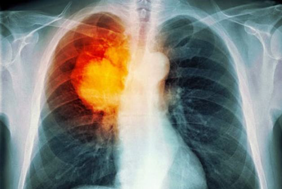 Ung thư màng phổi có thể gây nhiều biến chứng nguy hiểm đe dọa tính mạng người bệnh nếu không được phát hiện sớm