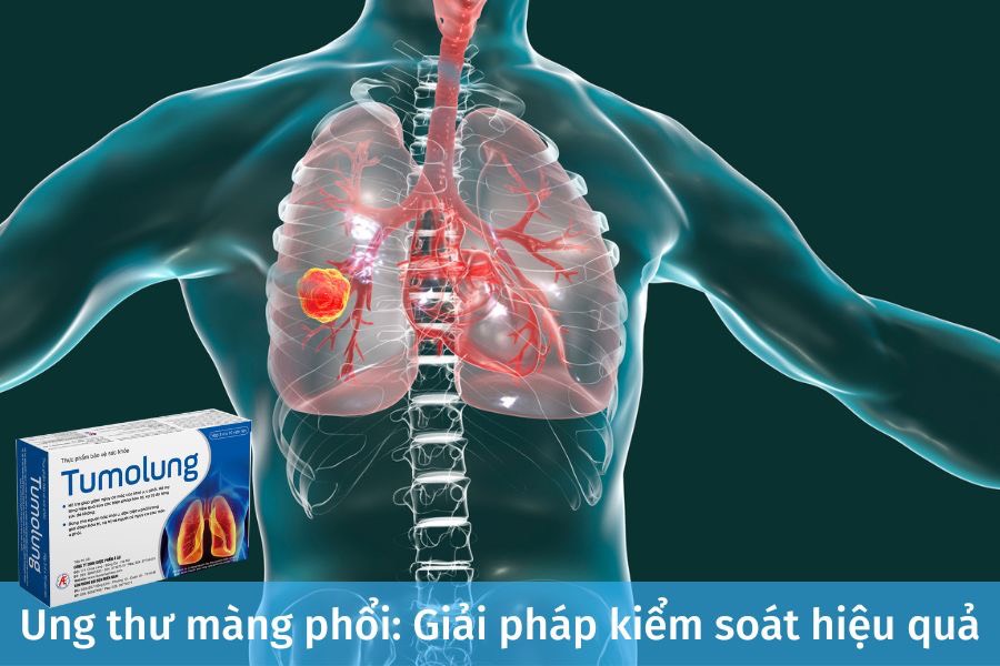 Ung thư màng phổi: Phát hiện sớm và kiểm soát hiệu quả nhờ Tumolung