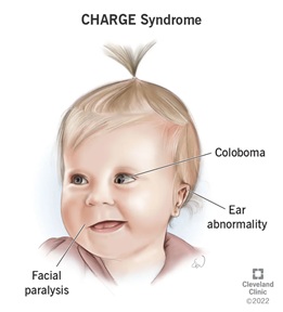 Hội chứng CHARGE là một tình trạng di truyền gây ra những thay đổi đối với mắt, tai và khuôn mặt của trẻ (Ảnh minh họa)